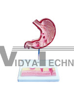 The dissection model of diseased stomach